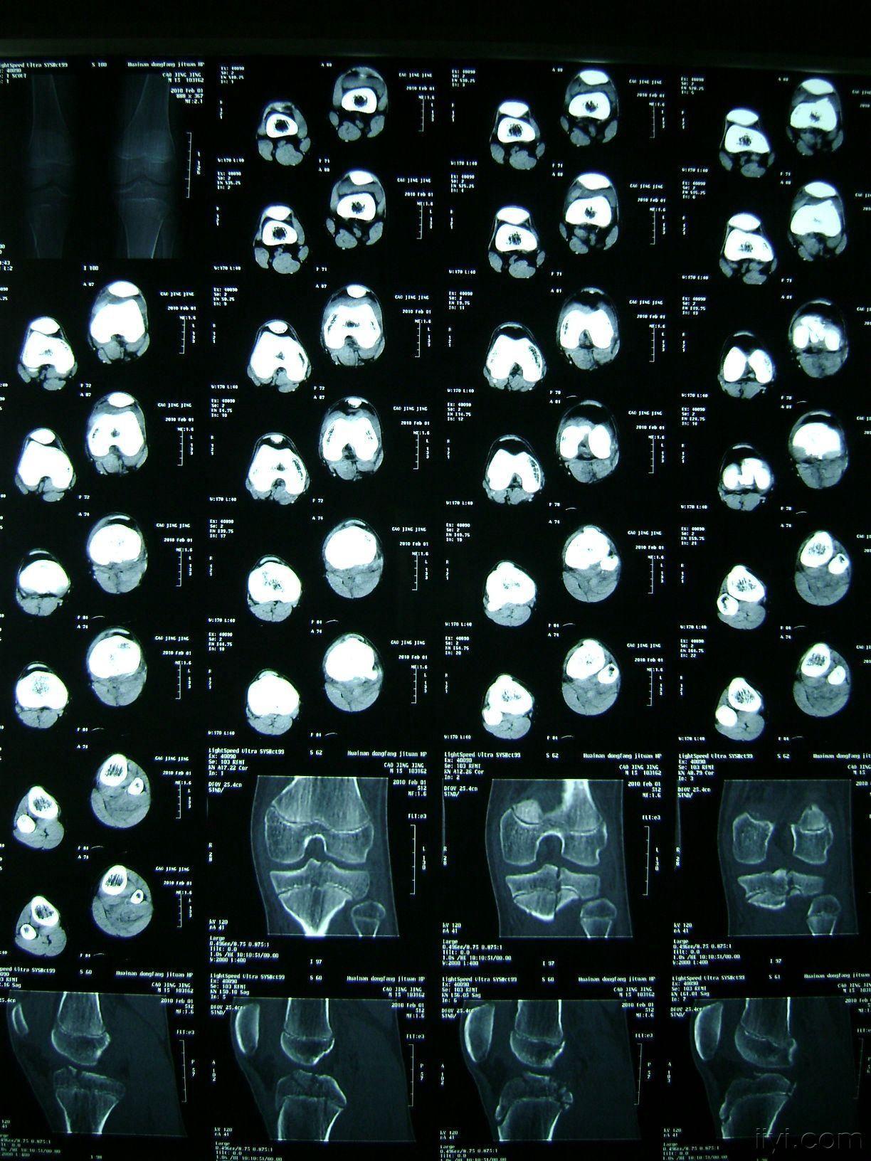 左膝关节胫骨平台骨骺损伤4型