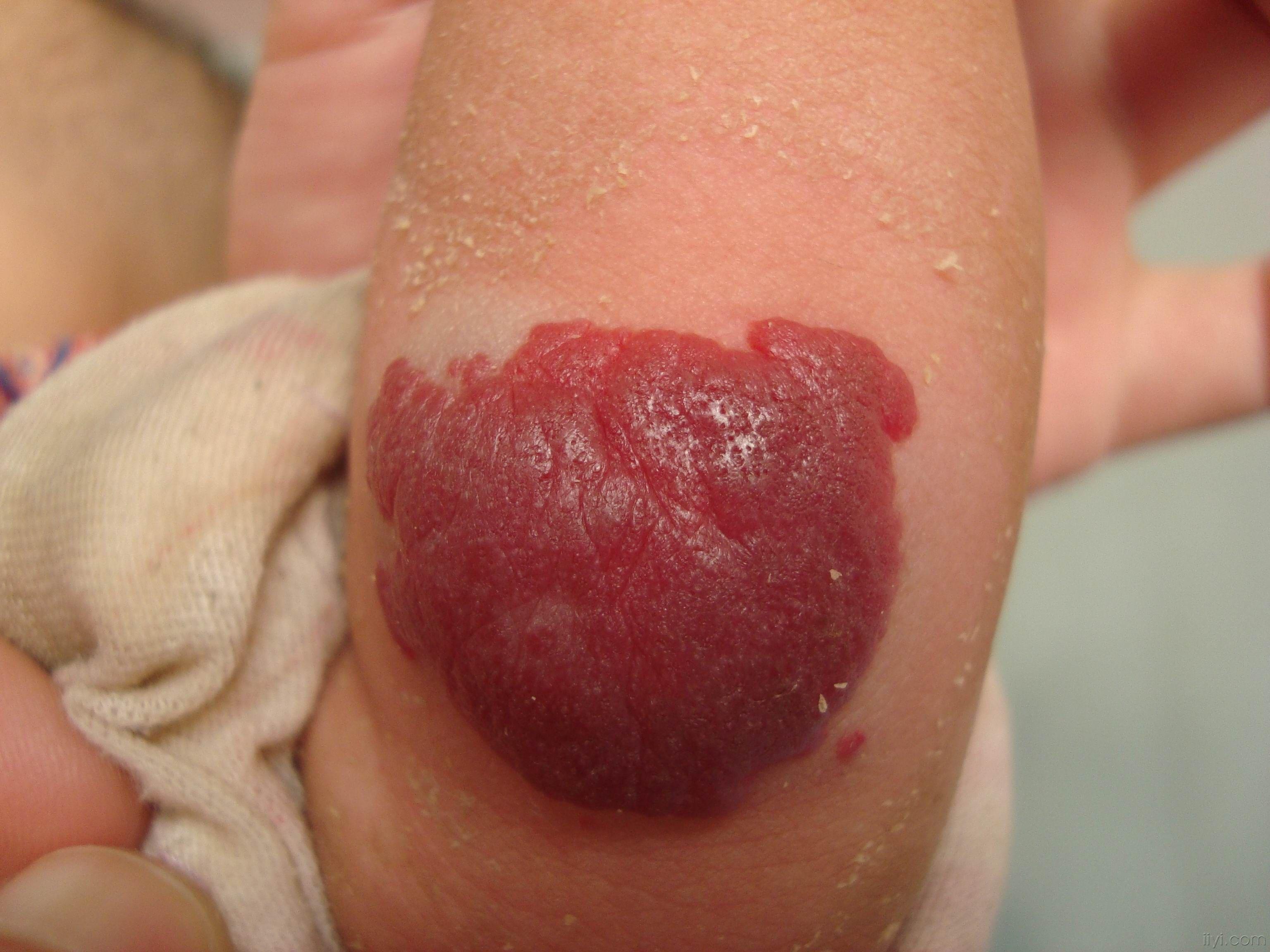 鲜艳的血管瘤 - 皮肤及性传播疾病讨论版 - 爱爱医医学论坛