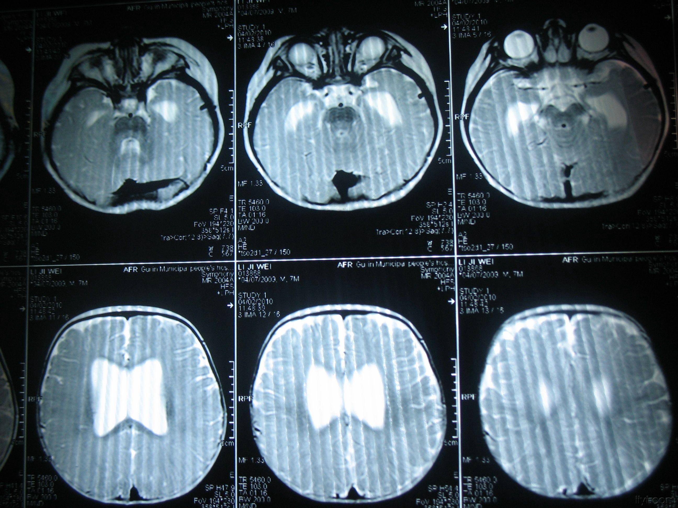 七个半月小儿核磁共振图像