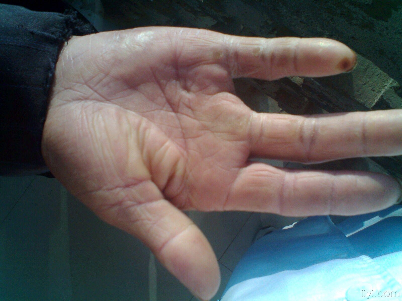 手指坏死早期症状图片图片