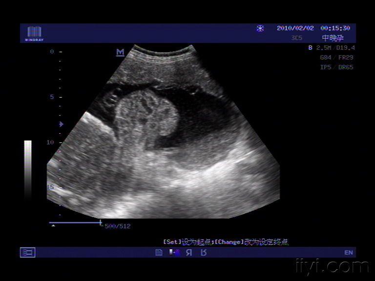胎儿脐带彩超图片