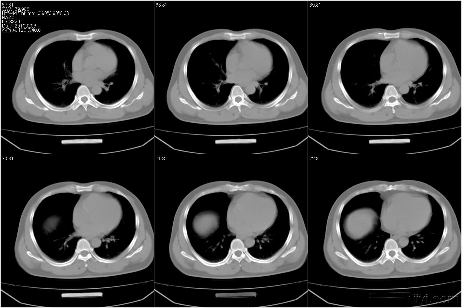 肺部ct请同行帮忙阅片