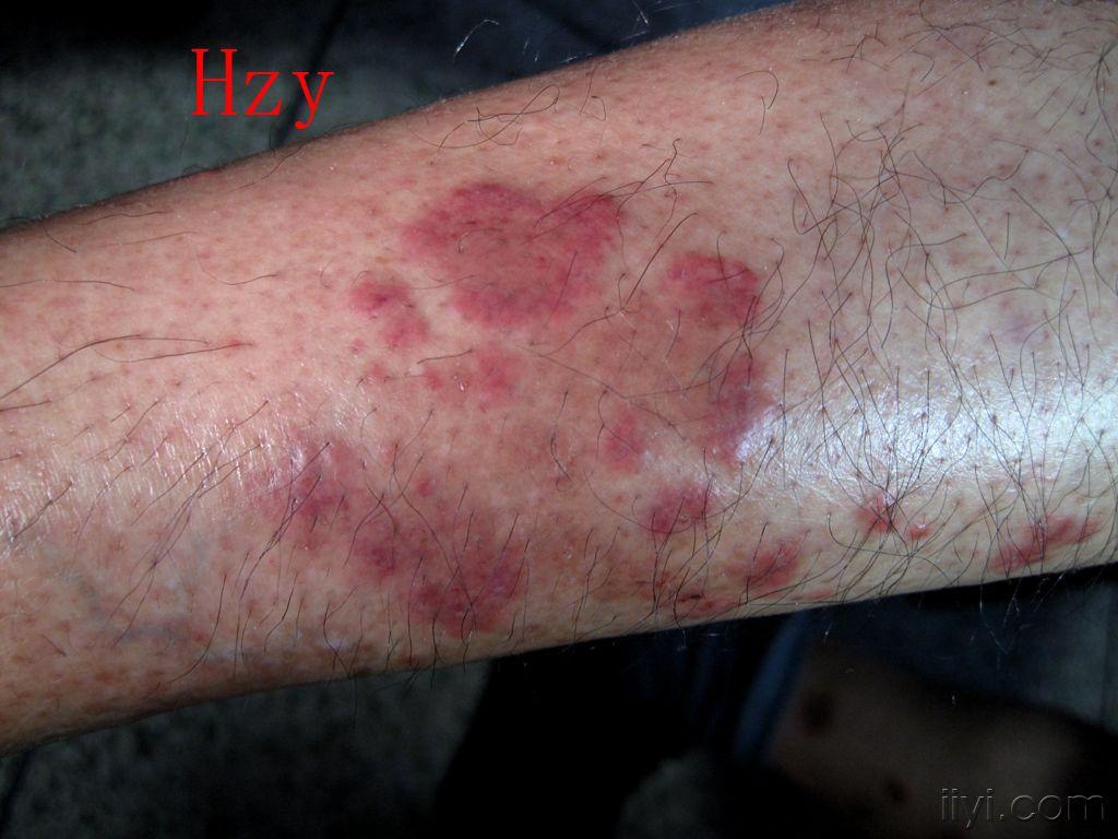 下肢血管炎的症状图片图片