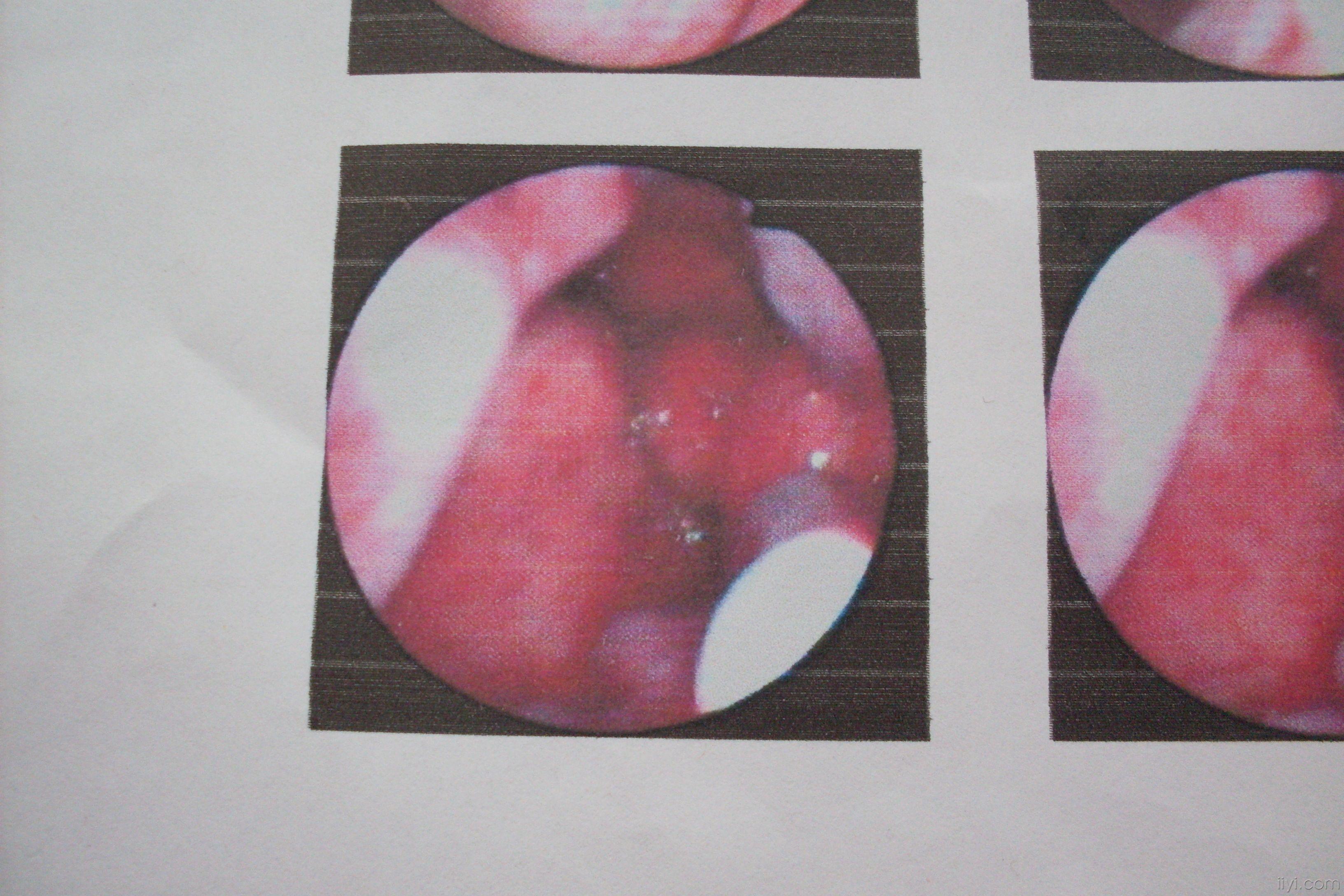 鼻咽肿物照片炎症图片