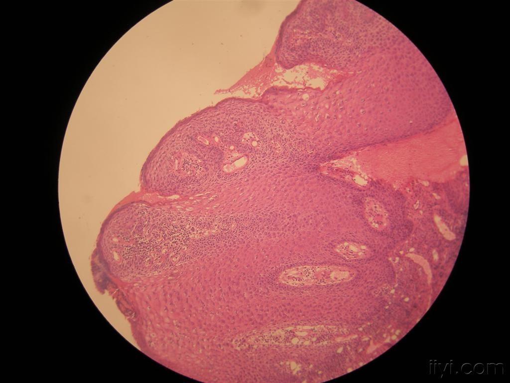 讨论病例1浆细胞性龟头炎 ca