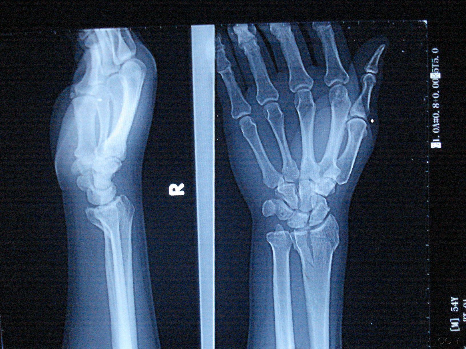 手右桡骨远端骨折图图片