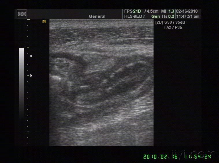 守年刚做的病人,很好看的阑尾炎图片 - 超声医学讨论版 - 爱爱医医学