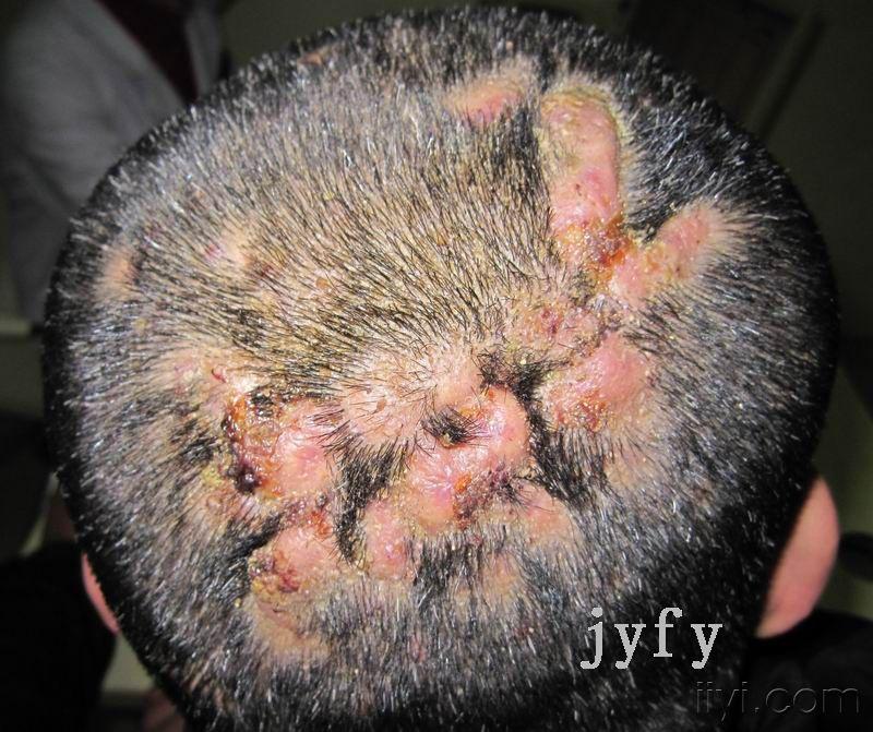 典型病例2头部脓肿性穿掘性毛囊周围炎