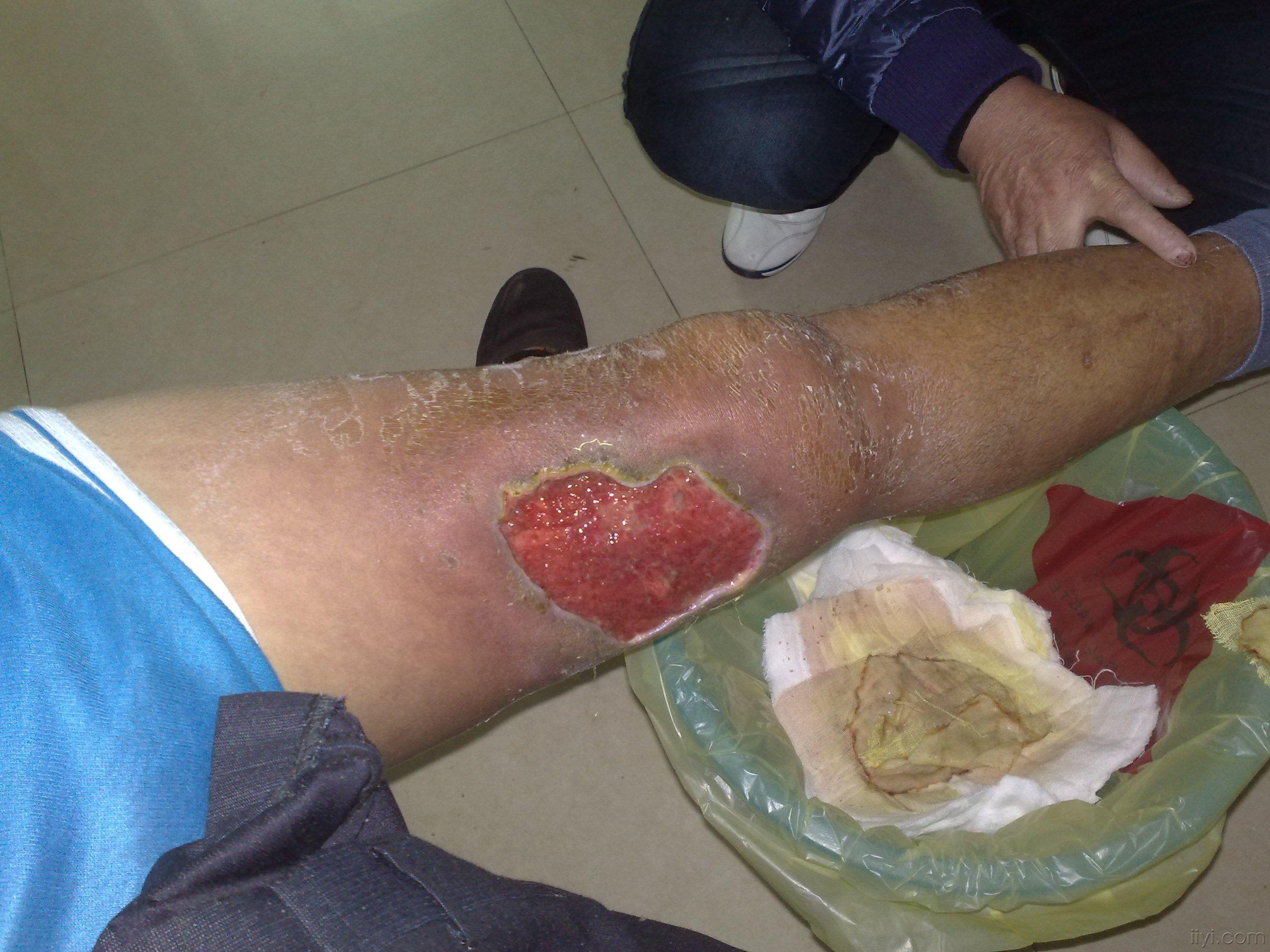 大家来看看这个大腿缺损怎么处理好在线等