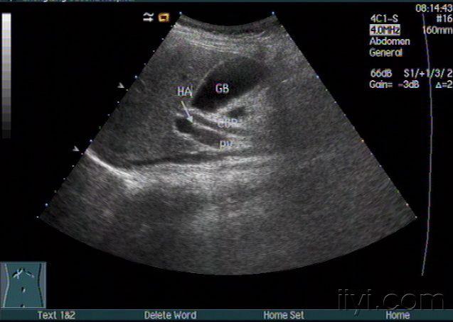 胆道闭锁尿液图片图片