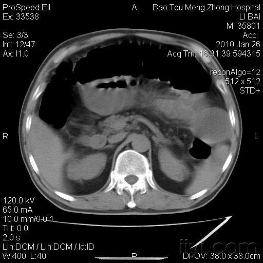 阑尾炎是怎么导致的 10022419094c6c98593e143a62.jpg