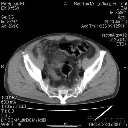 阑尾炎是怎么导致的 10022419102b0bf000c09e14cc.jpg