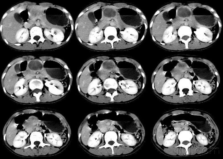 胰腺占位病理公布