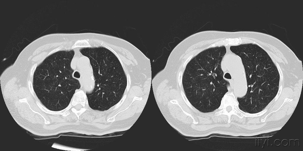 气管癌的白痰图片图片