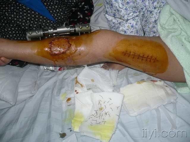 大家来看看这个大腿缺损怎么处理好在线等