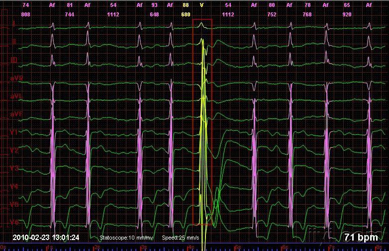 请教一份心电图房颤合并宽大畸形的qrs波