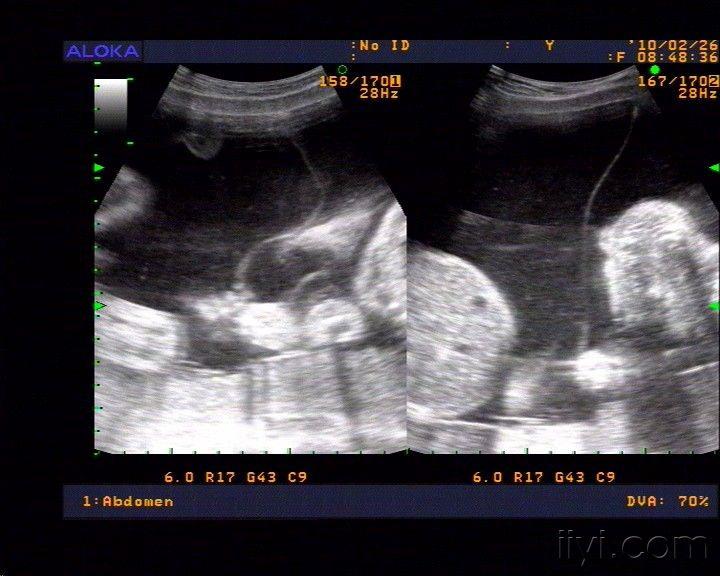 请看双胎妊娠这个应该是双羊膜囊双胎吧