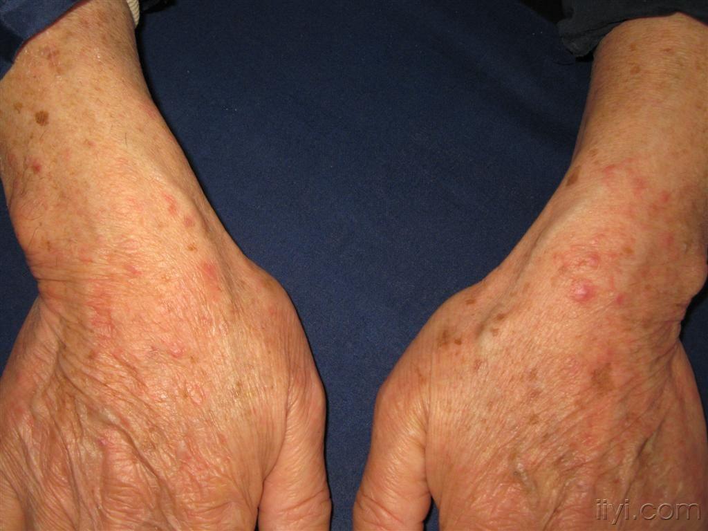 看图识病多形红斑