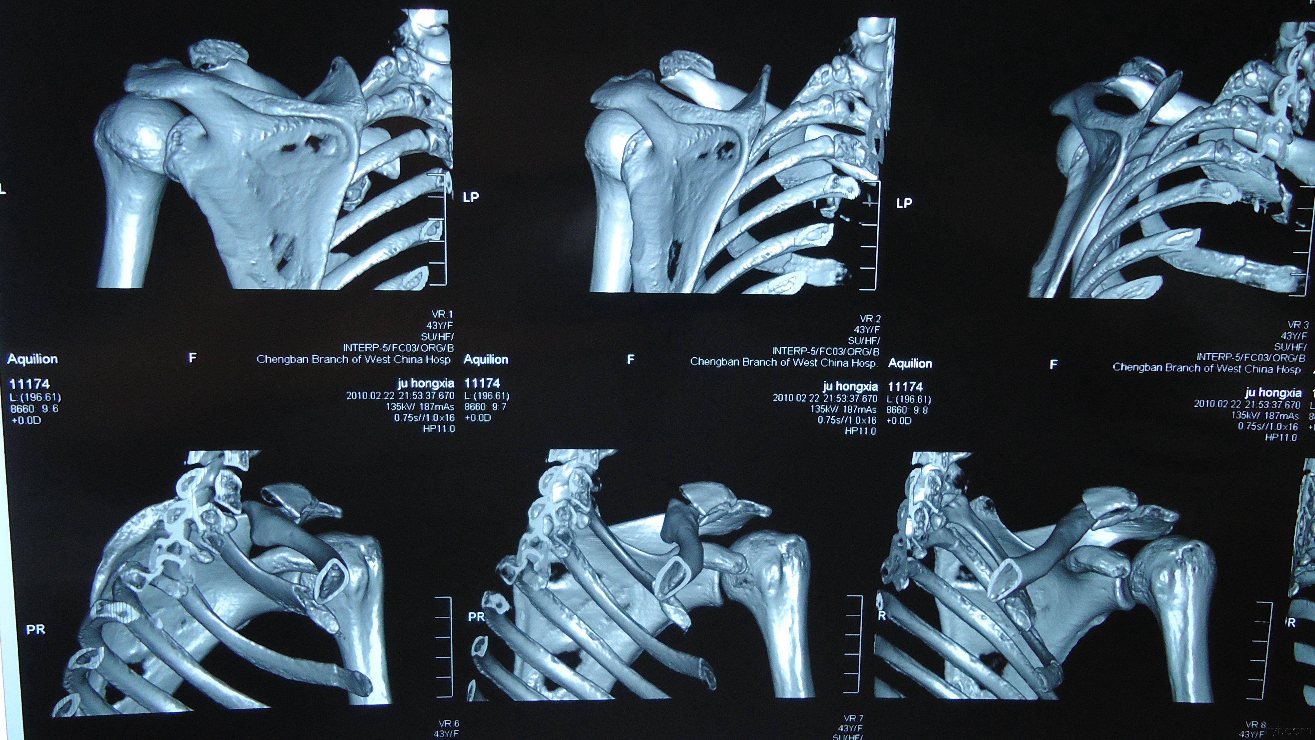 肩关节ct三维重建图片图片