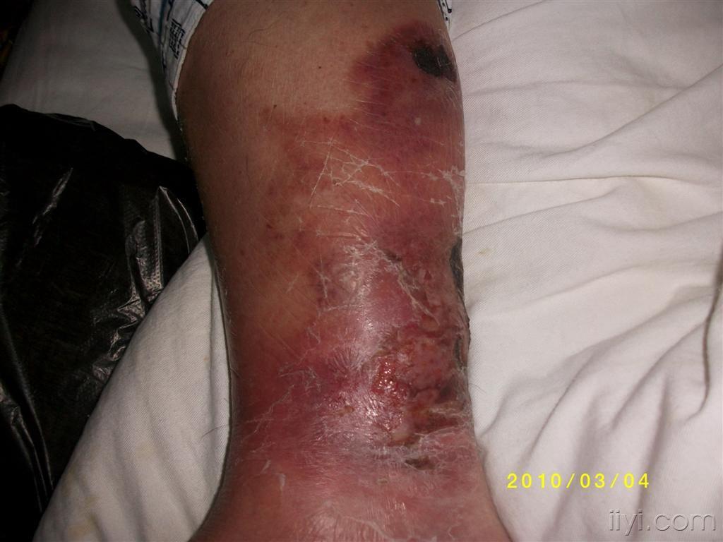 丹毒治疗12天后2月20日贴
