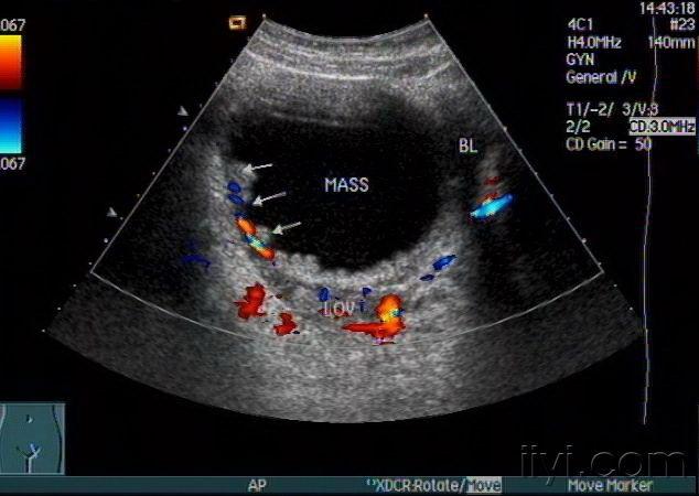 卵巢囊腺瘤超声图片图片
