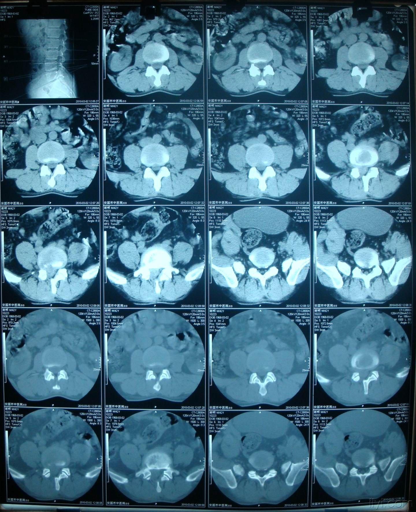 男42岁腰及右侧下肢疼痛3年加重5天