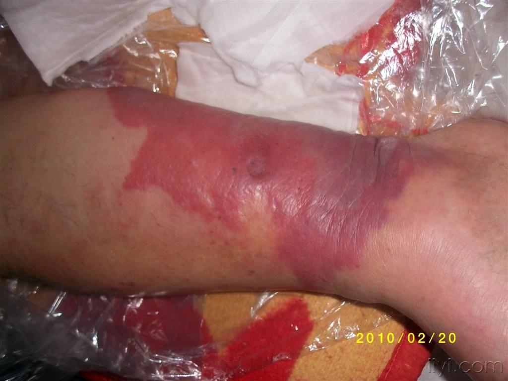 丹毒治疗12天后2月20日贴