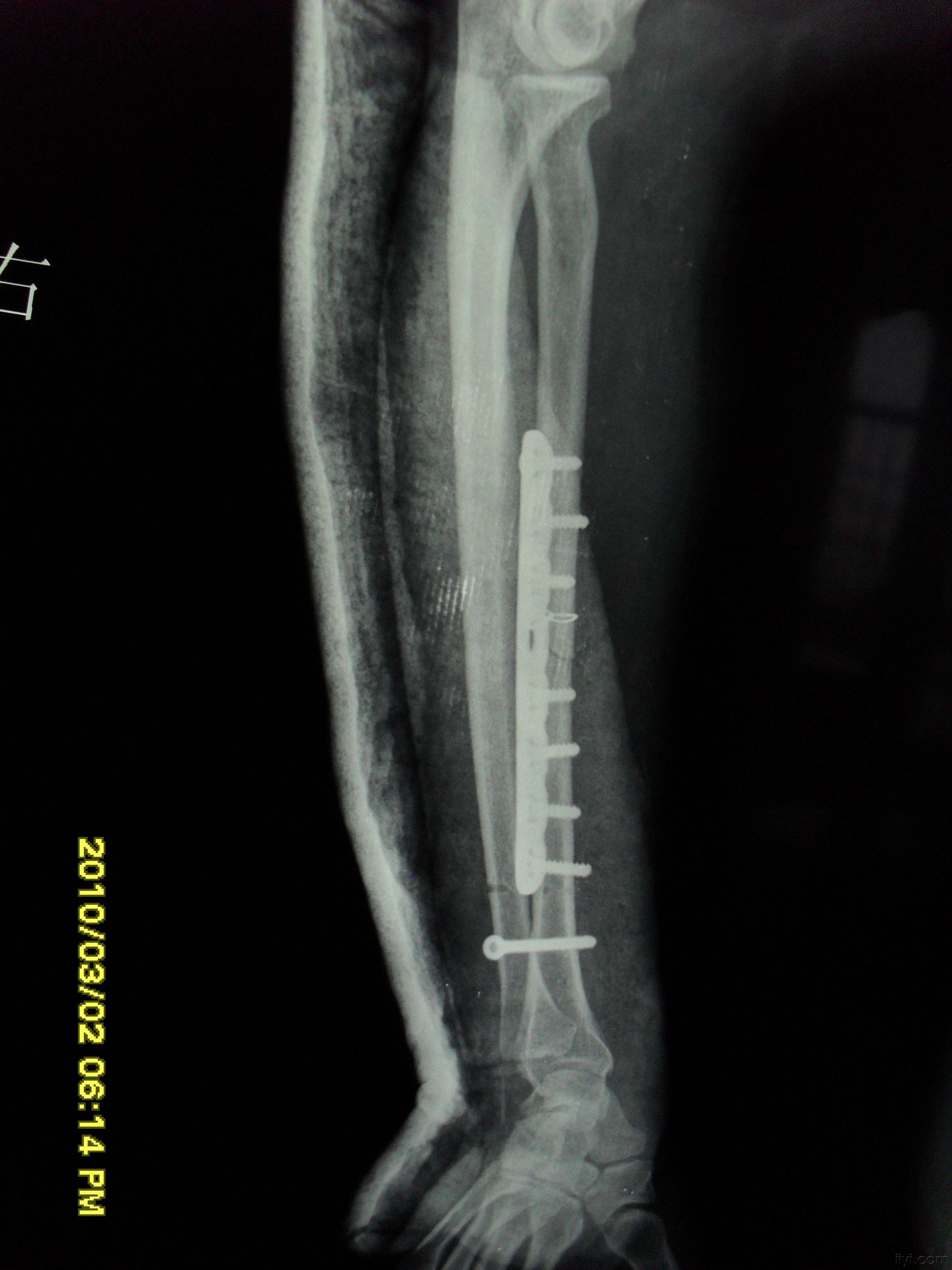 下尺桡关节脱位一例