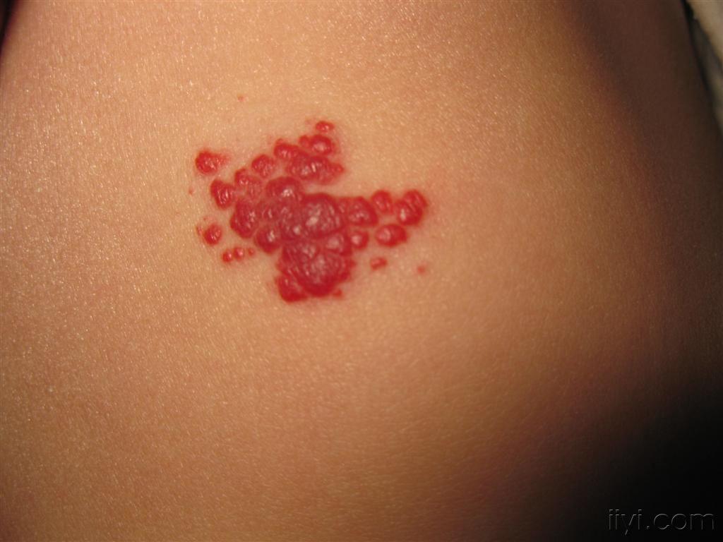 看图识病草莓状血管瘤