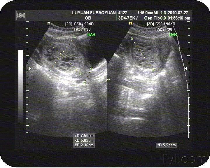 葡萄胎 超声医学讨论版 爱爱医医学论坛