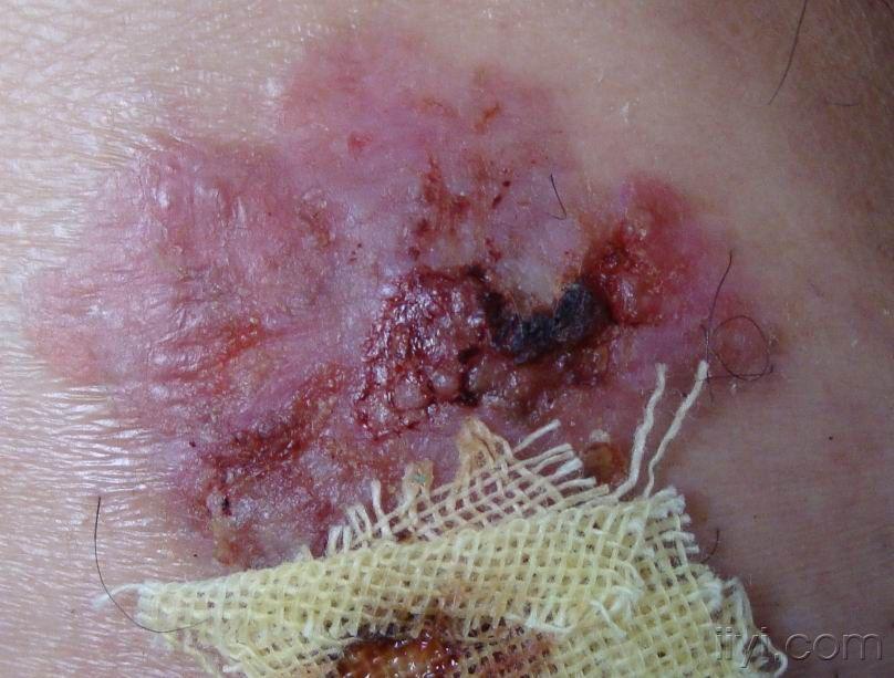 门诊图片10bowen病