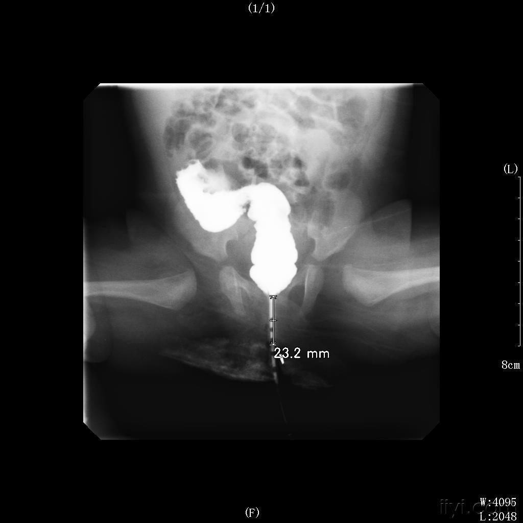 先天性肛门闭锁(不全)/狭窄