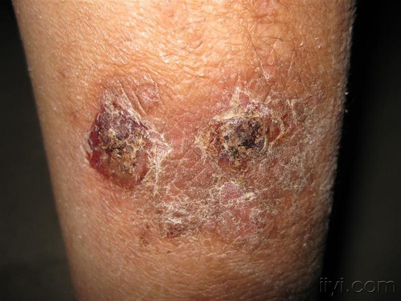 看图识病----胫前湿疹 - 皮肤及性传播疾病讨论版 - 爱爱医医学论坛