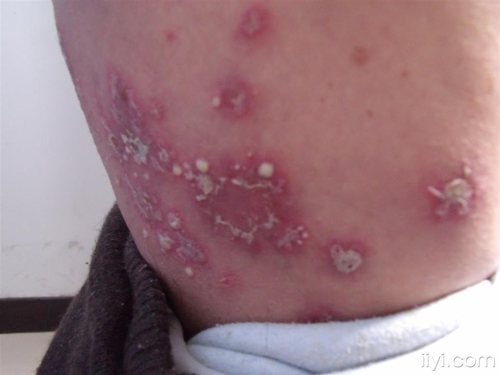 角层下脓疱性皮病--门诊照片 - 皮肤及性传播疾病讨论版 - 爱爱医医学