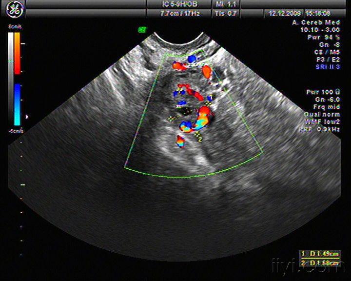 右侧卵巢内黄体血肿