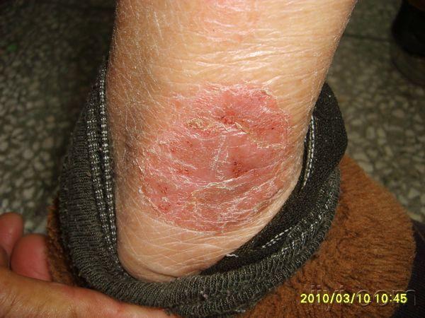 看图说话 - 皮肤及性传播疾病讨论版 - 爱爱医医学论坛