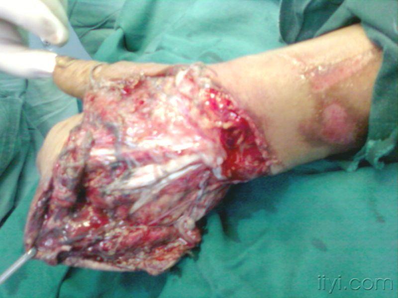 水泥机器绞砸伤手掌