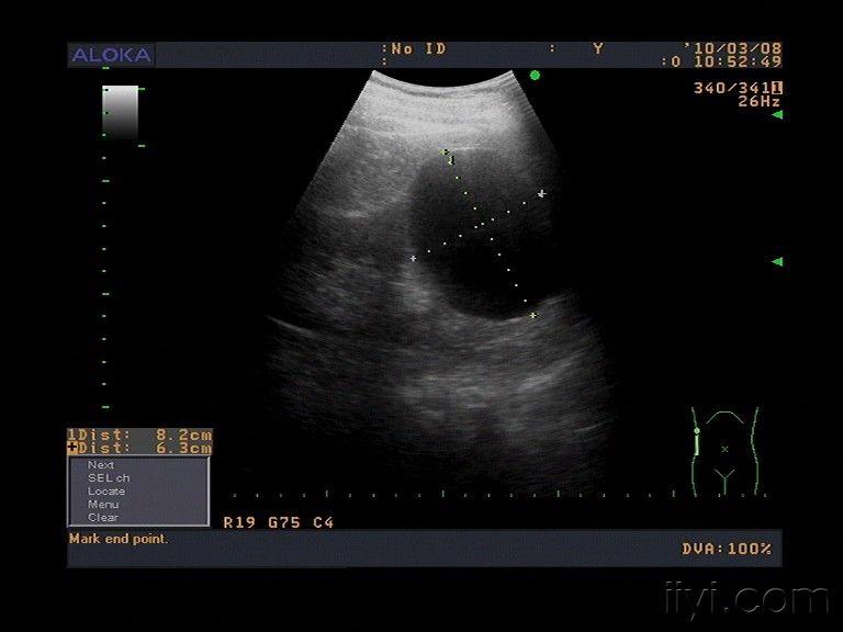 差点漏诊的脾囊肿 超声医学讨论版 爱爱医医学论坛
