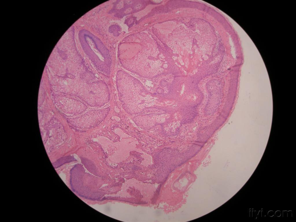皮脂腺切片图片
