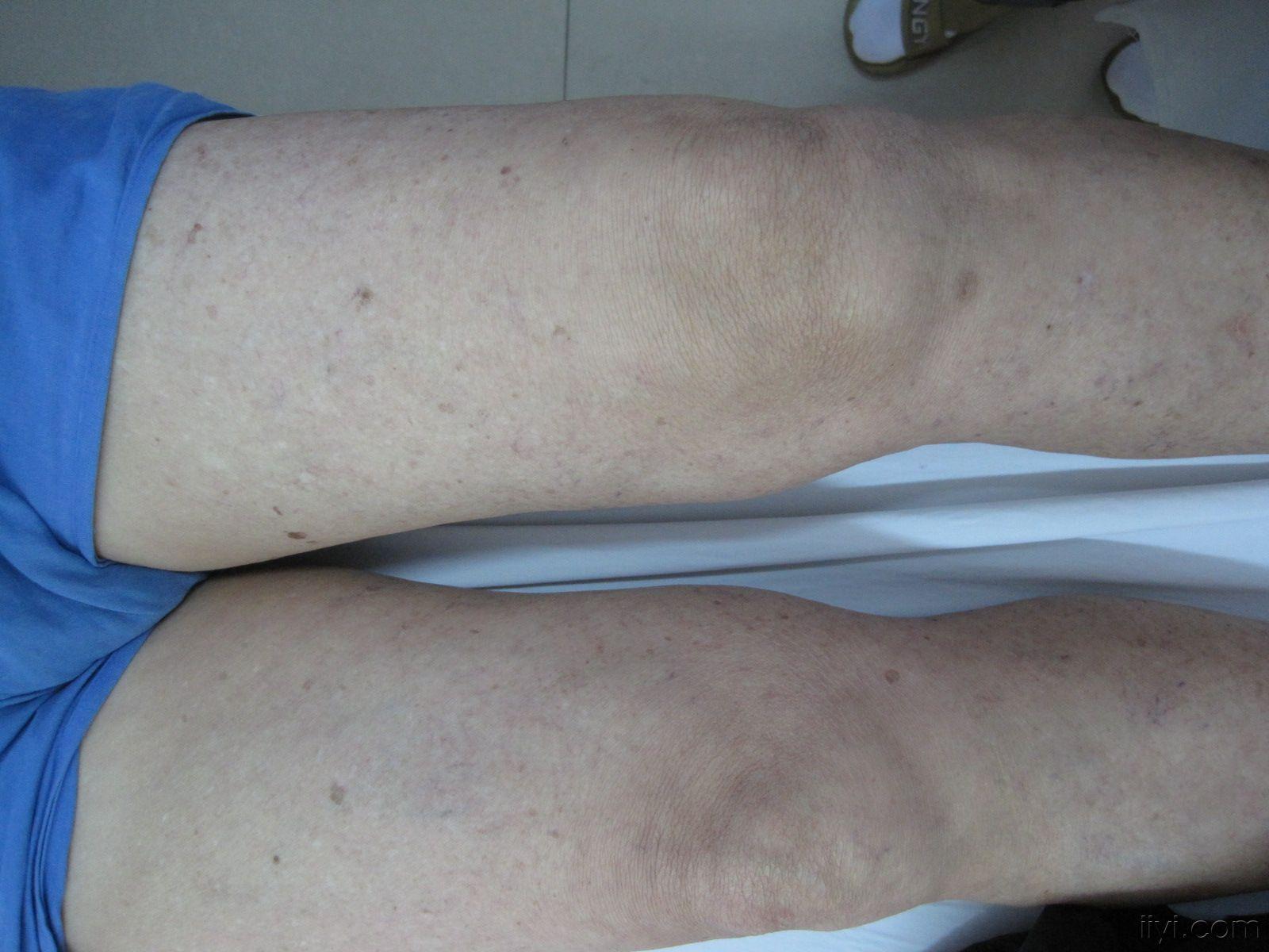一膝关节错位剧痛患者如何手法治疗