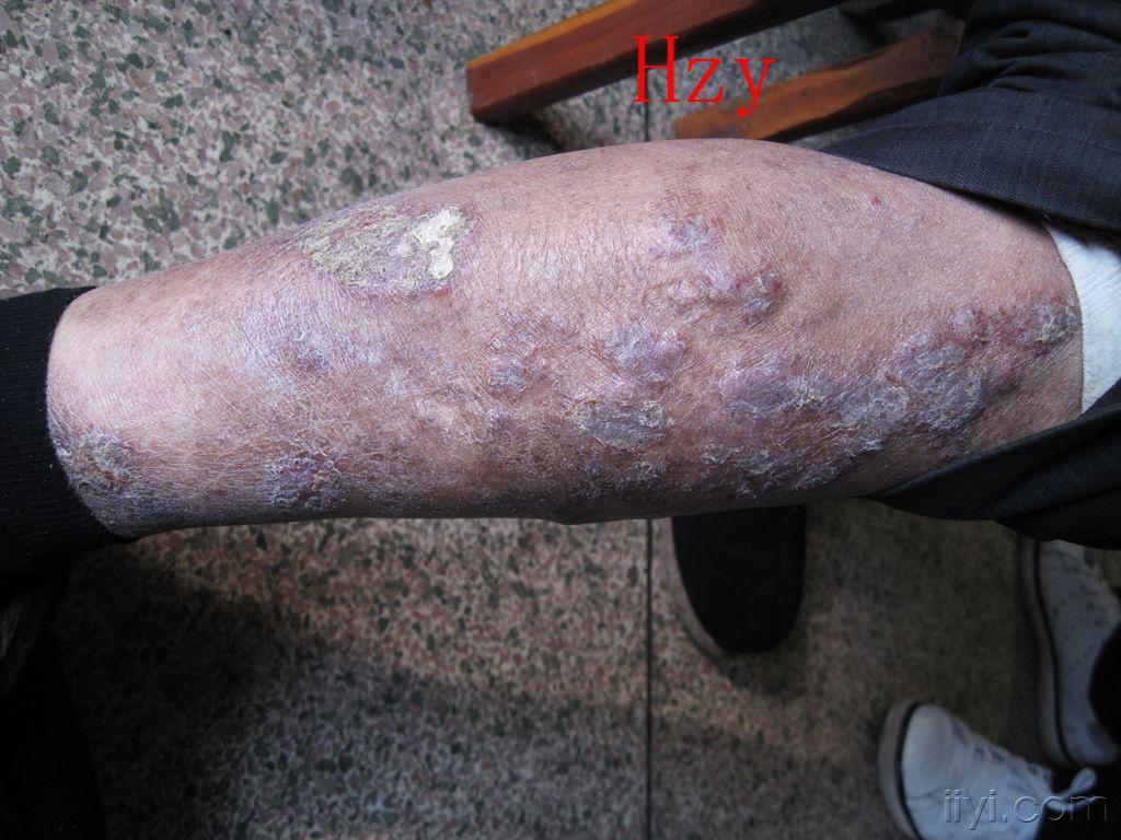 两下肢皮损十多年躯干皮损才23年公布答案淤积性皮炎和湿疹