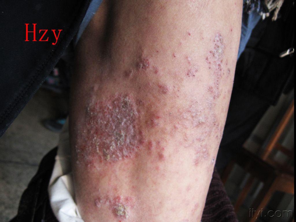 两下肢皮损十多年躯干皮损才23年公布答案淤积性皮炎和湿疹