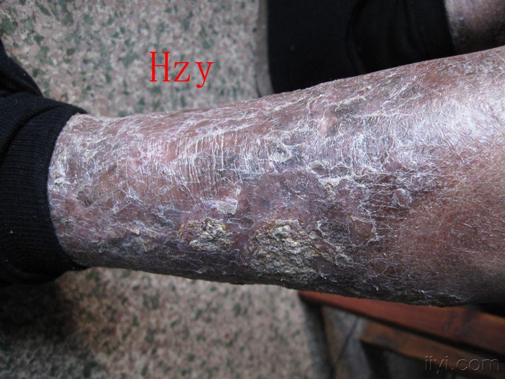 两下肢皮损十多年躯干皮损才23年公布答案淤积性皮炎和湿疹