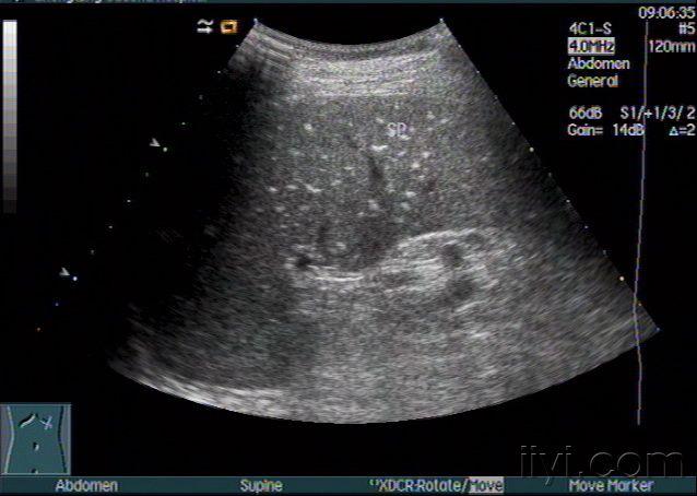 脾大,脾实质弥漫分布点状强回声_zengerya - 超声医学讨论版 - 爱爱医