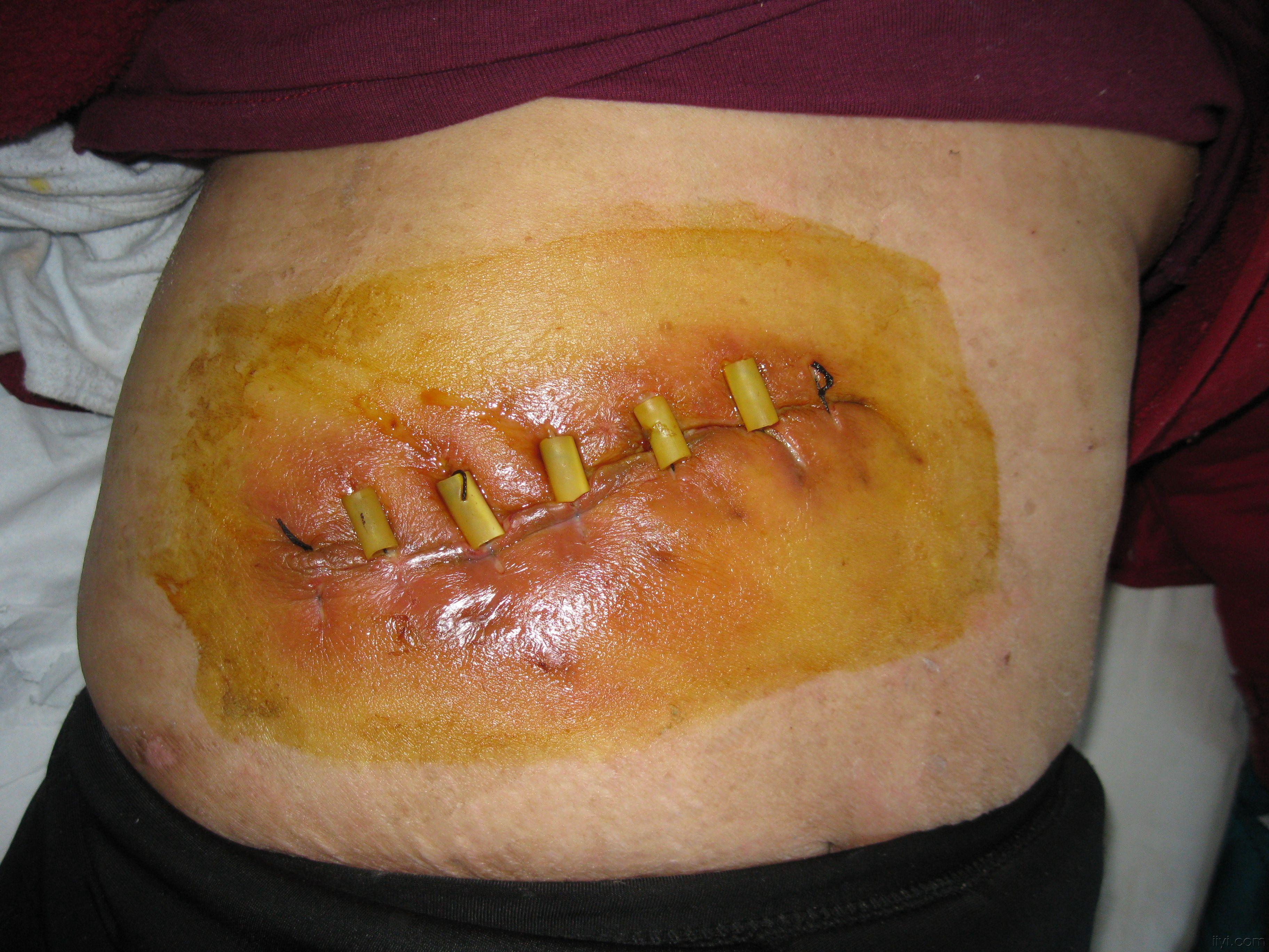 手术伤口照片图片