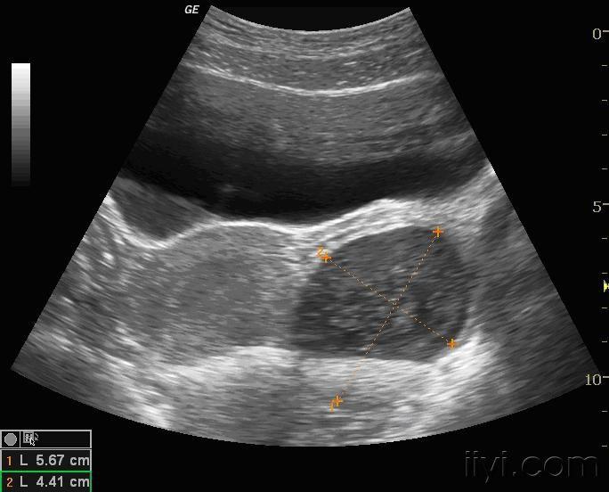 左側卵巢佔位(有病檢結果) - 超聲醫學討論版 - 愛愛醫醫學論壇