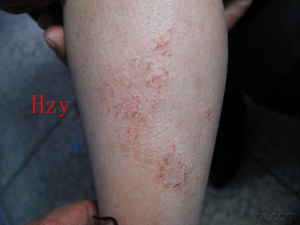 两下肢皮损.公布答案:湿疹