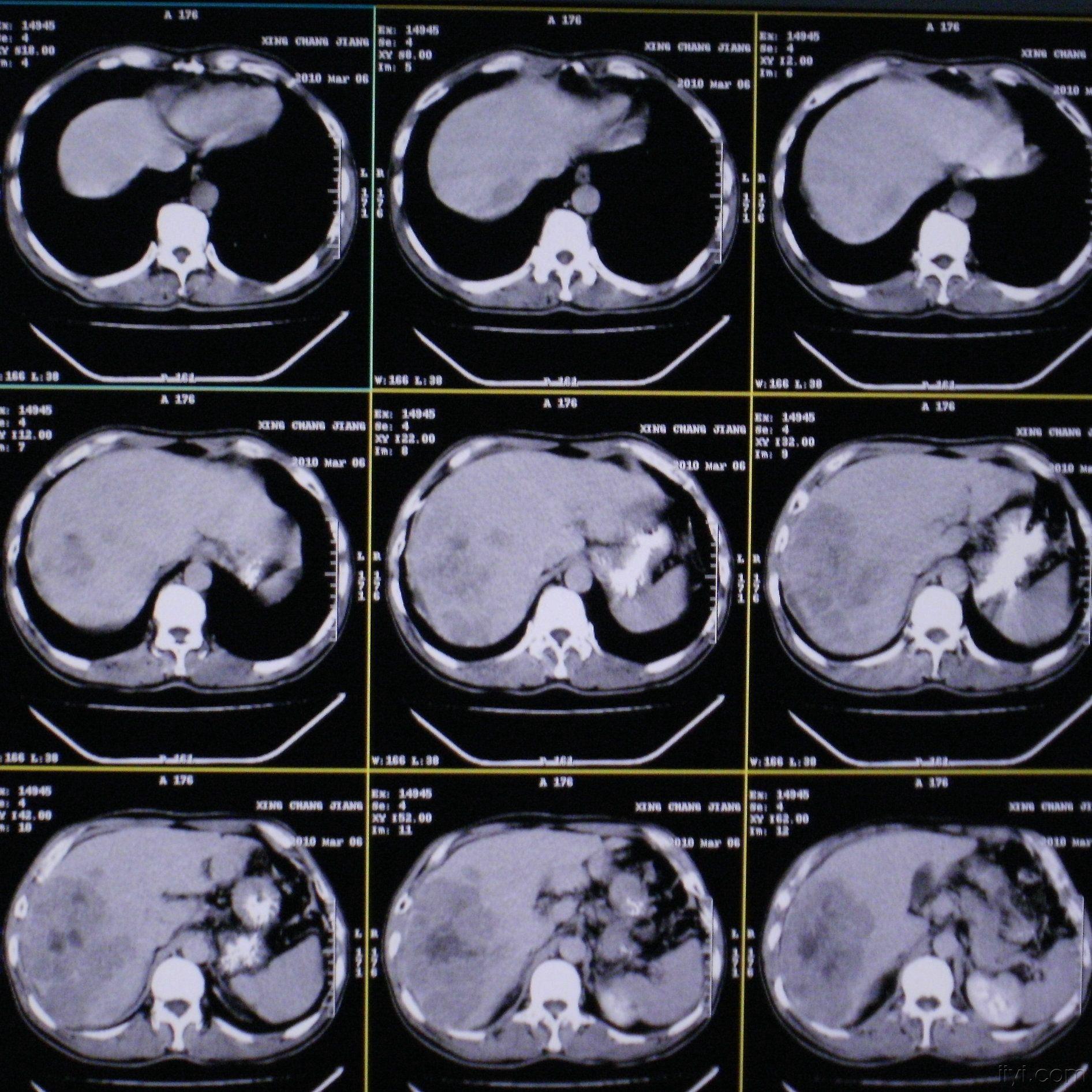[读片]腹部/ct平扫 增强/病理已公布/20100316