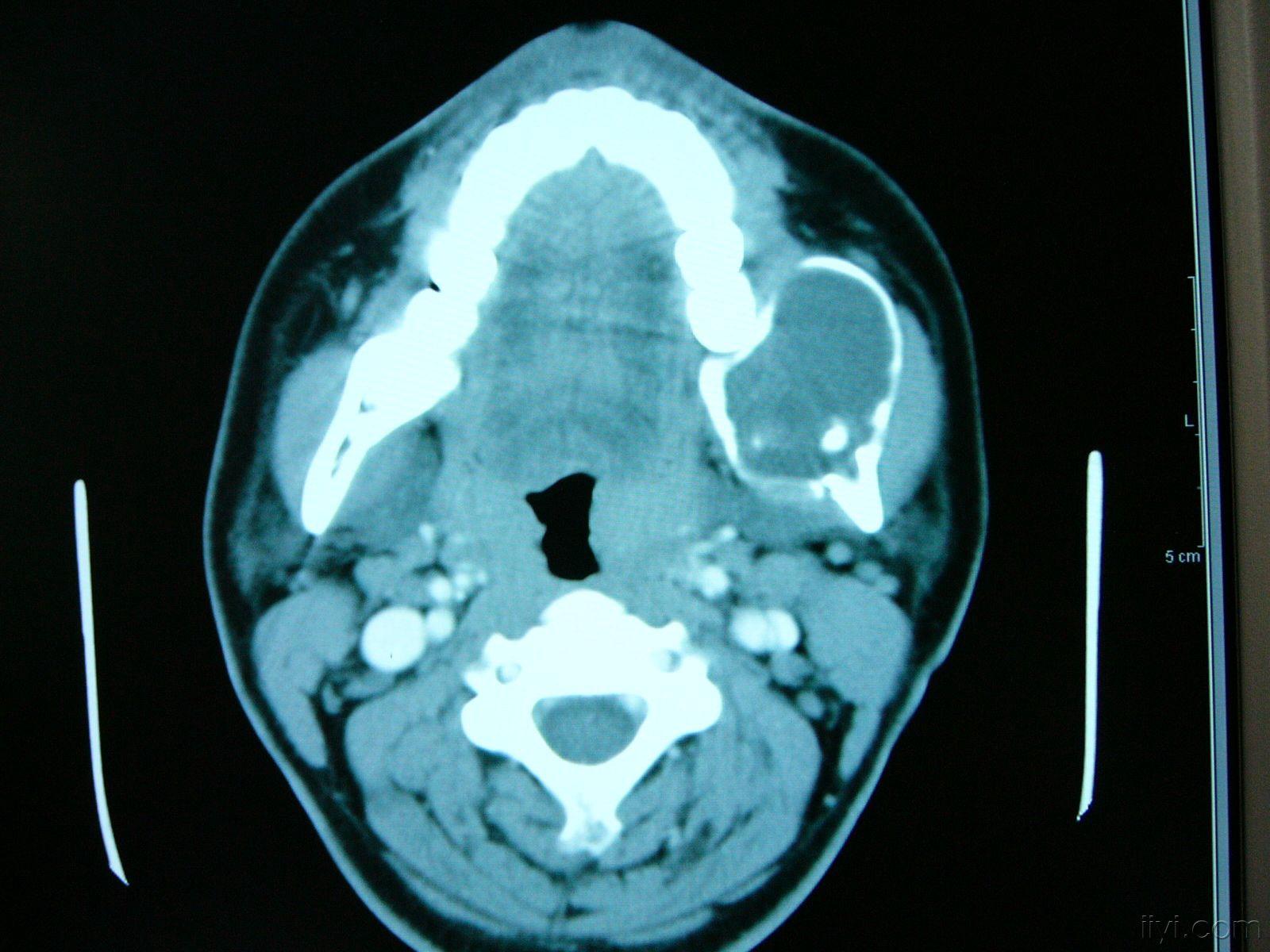 下颌骨囊肿图片 早期图片