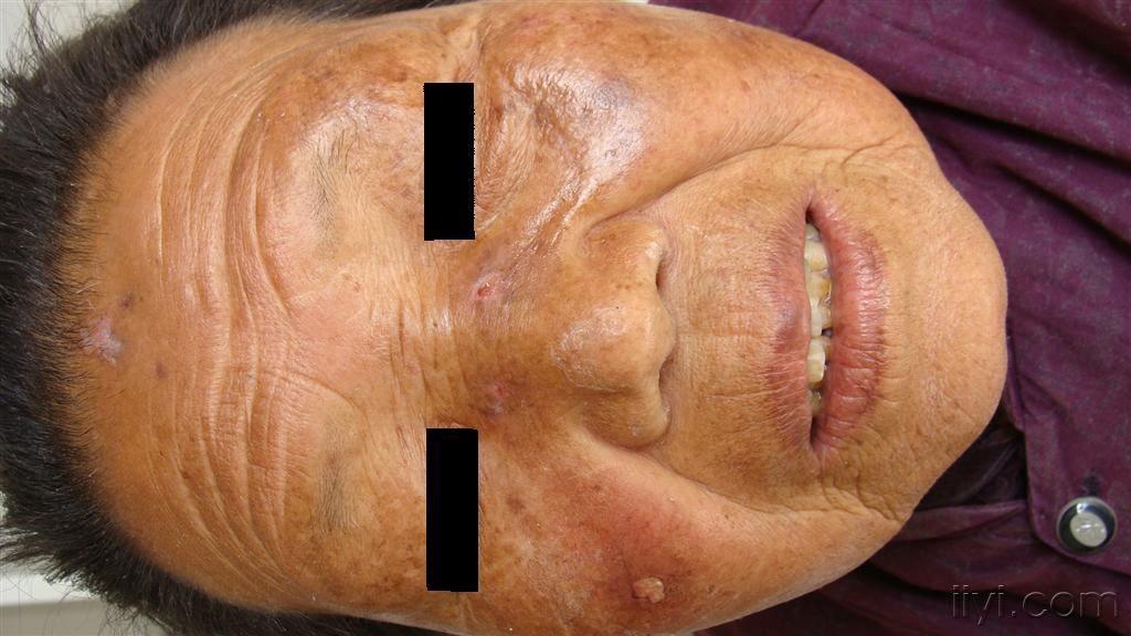老人皮肤病的种类图片图片